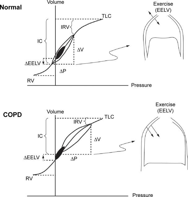 https://cdn.ncbi.nlm.nih.gov/pmc/blobs/8c04/4765947/bf40f0b554e7/copd-11-003Fig1.jpg