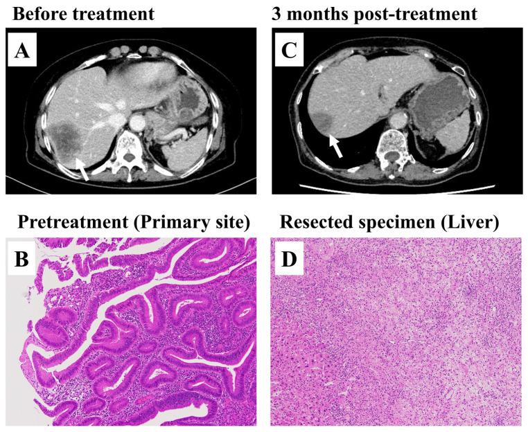 https://cdn.ncbi.nlm.nih.gov/pmc/blobs/a2a0/12248757/f718984ed92a/cancers-17-02233-g002.jpg